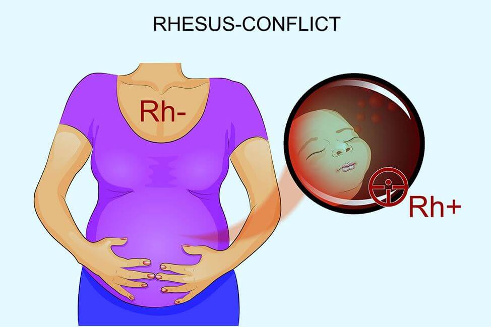 Резус конфликт во время беременности
